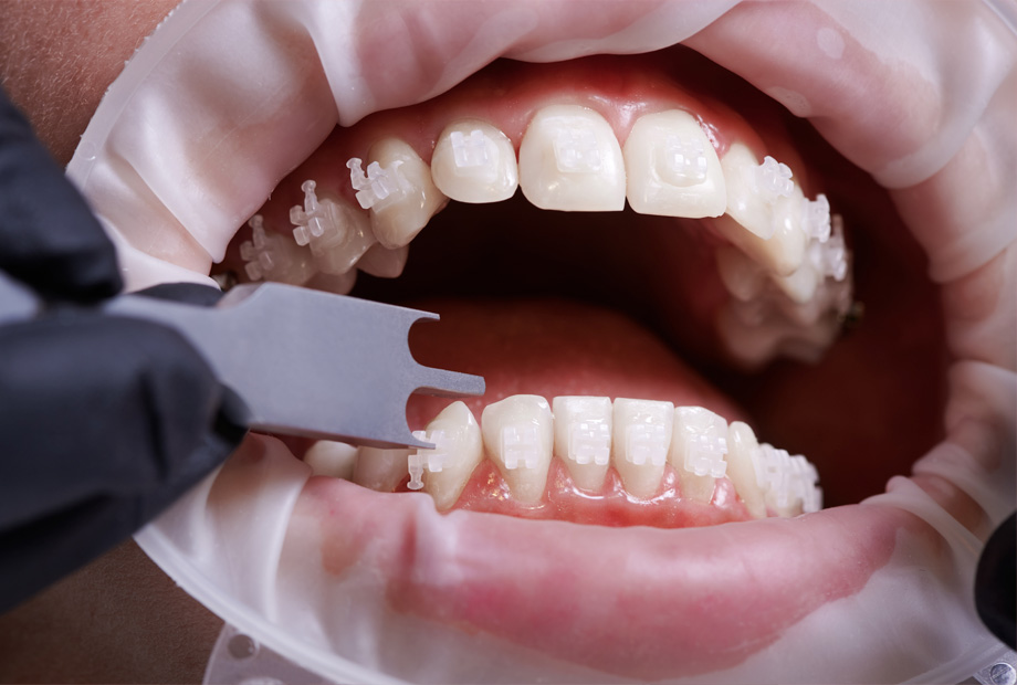 img-trmnt-braces-03
